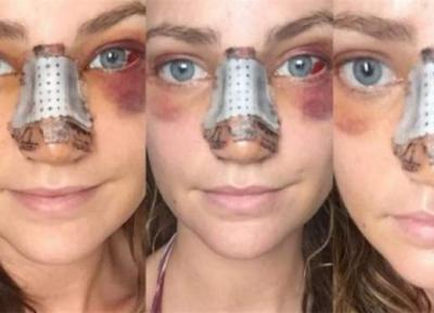 جراحی بینی چه عوارضی دارد؟ جراحی بینی چه عوارضی دارد؟